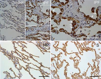 The Expression of AQP1 IS Modified in Lung of Patients With Idiopathic Pulmonary Fibrosis: Addressing a Possible New Target